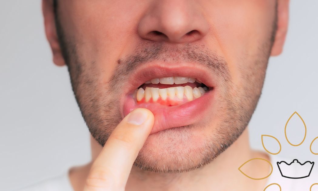 qué es la periodontitis qué es la periodontitis